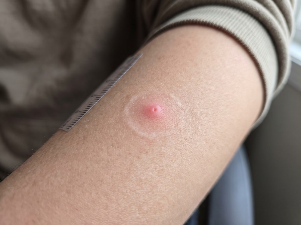 Close-up of a fresh cottonwood borer bite showing a small puncture mark with mild redness and a trace of blood